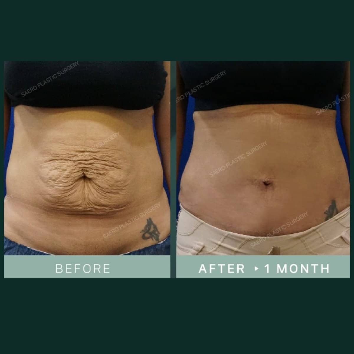 Case 19248 - tummy tuck