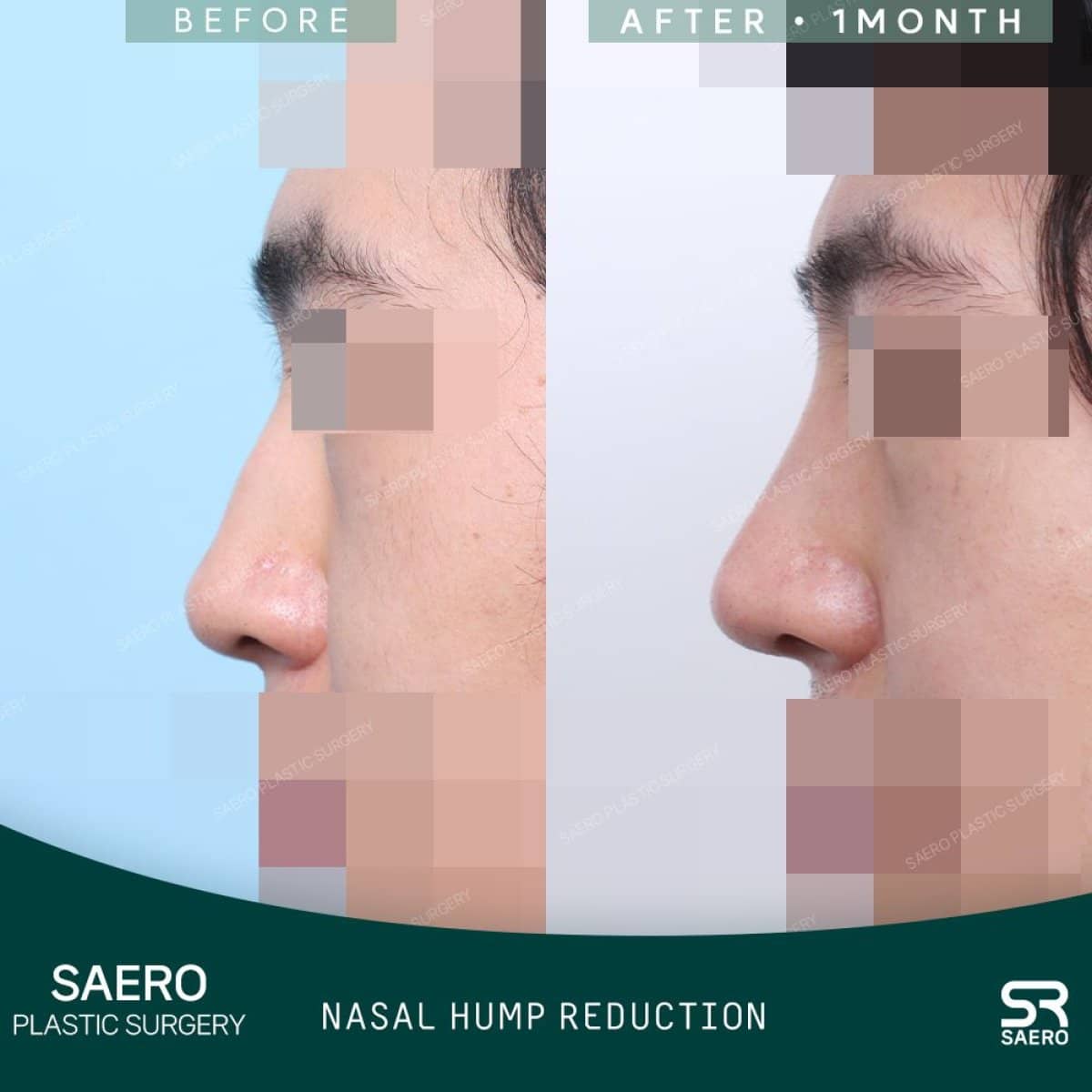 Case 19250 - open rhinoplasty