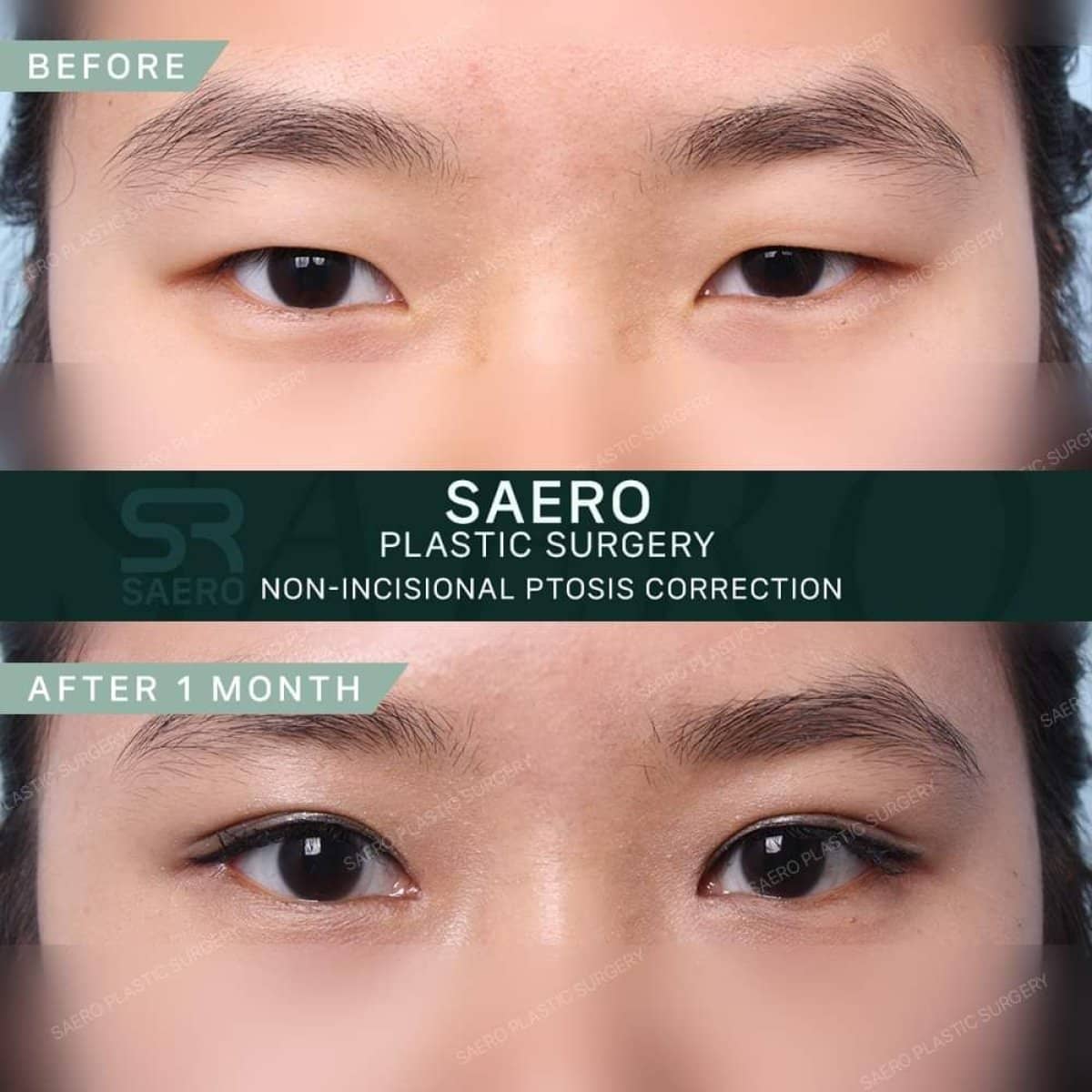 Case 19251 - non-incisional ptosis correction
