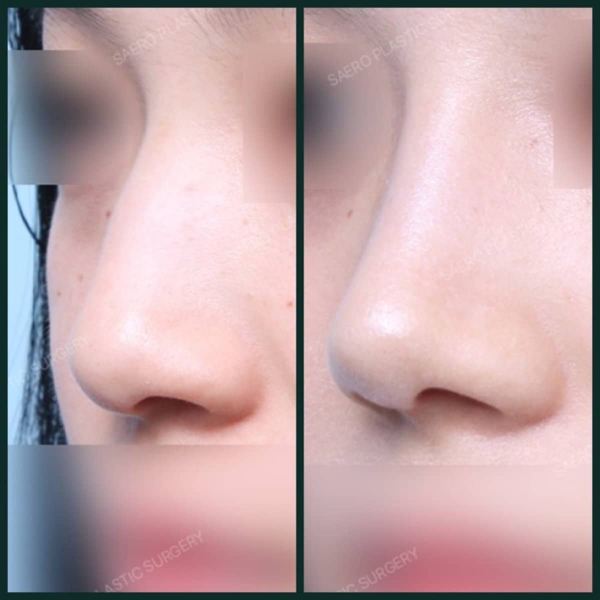 Case 19255 - rhinoplasty