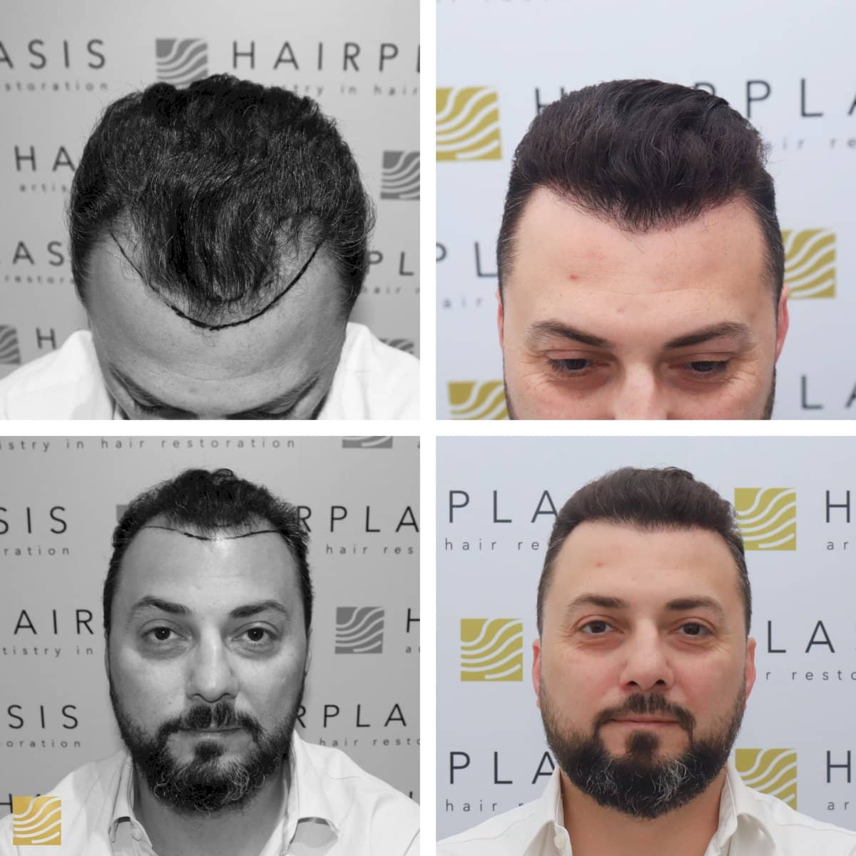 Case 19264 - FUE hair transplant