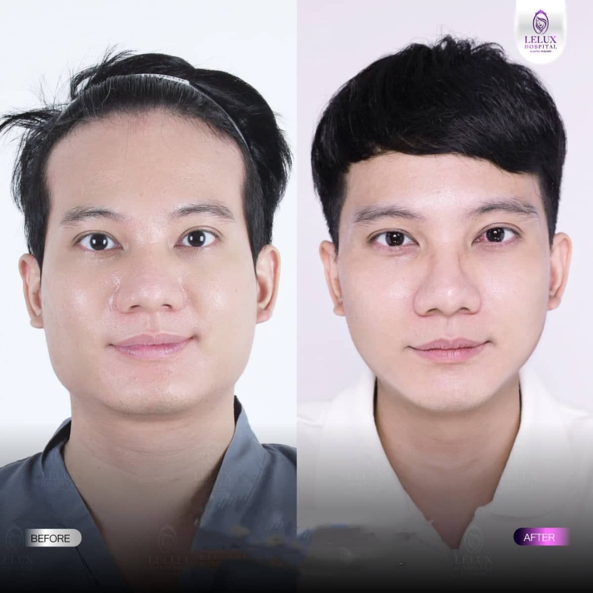 Case 19277 - cheekbone reduction