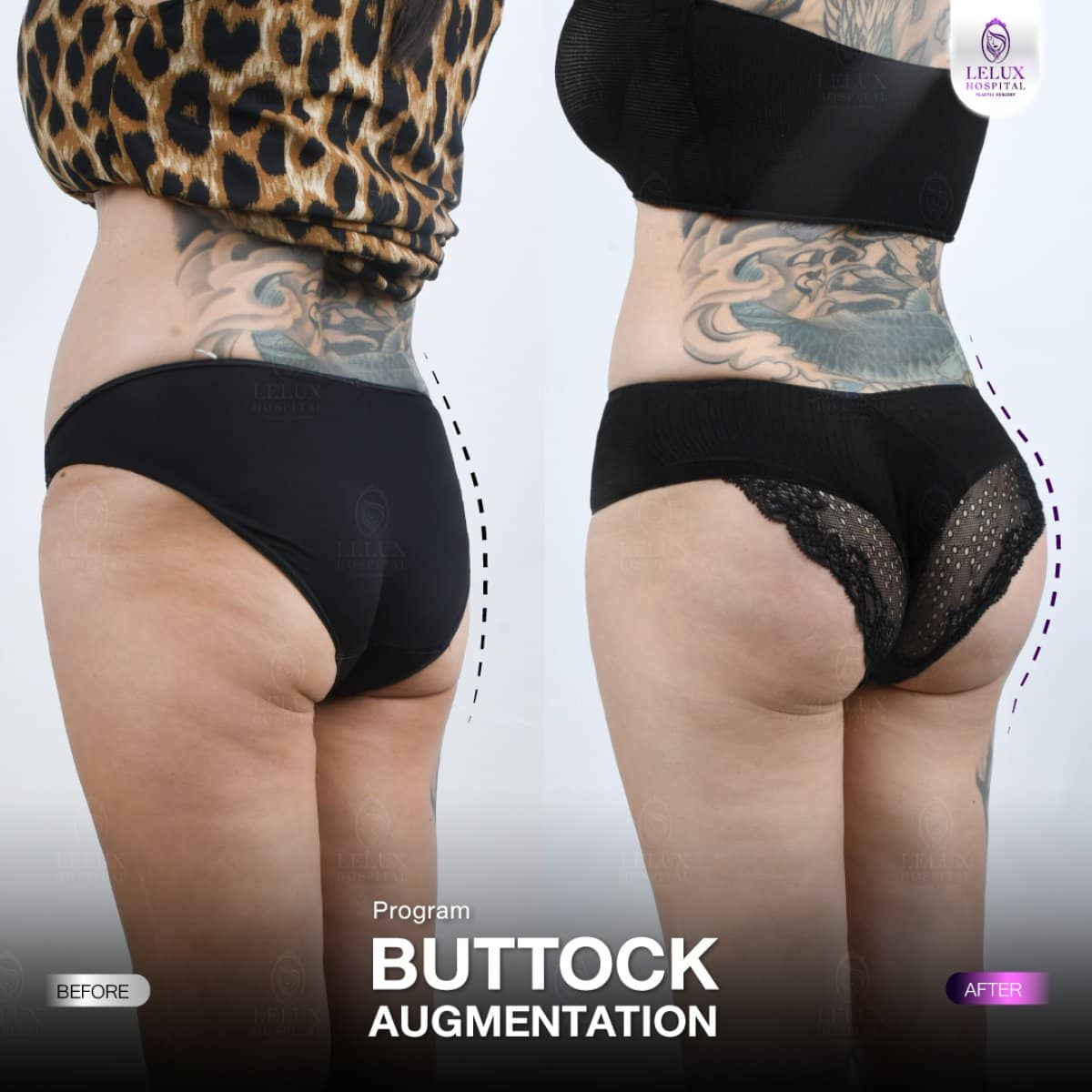 Case 19281 - buttock augmentation