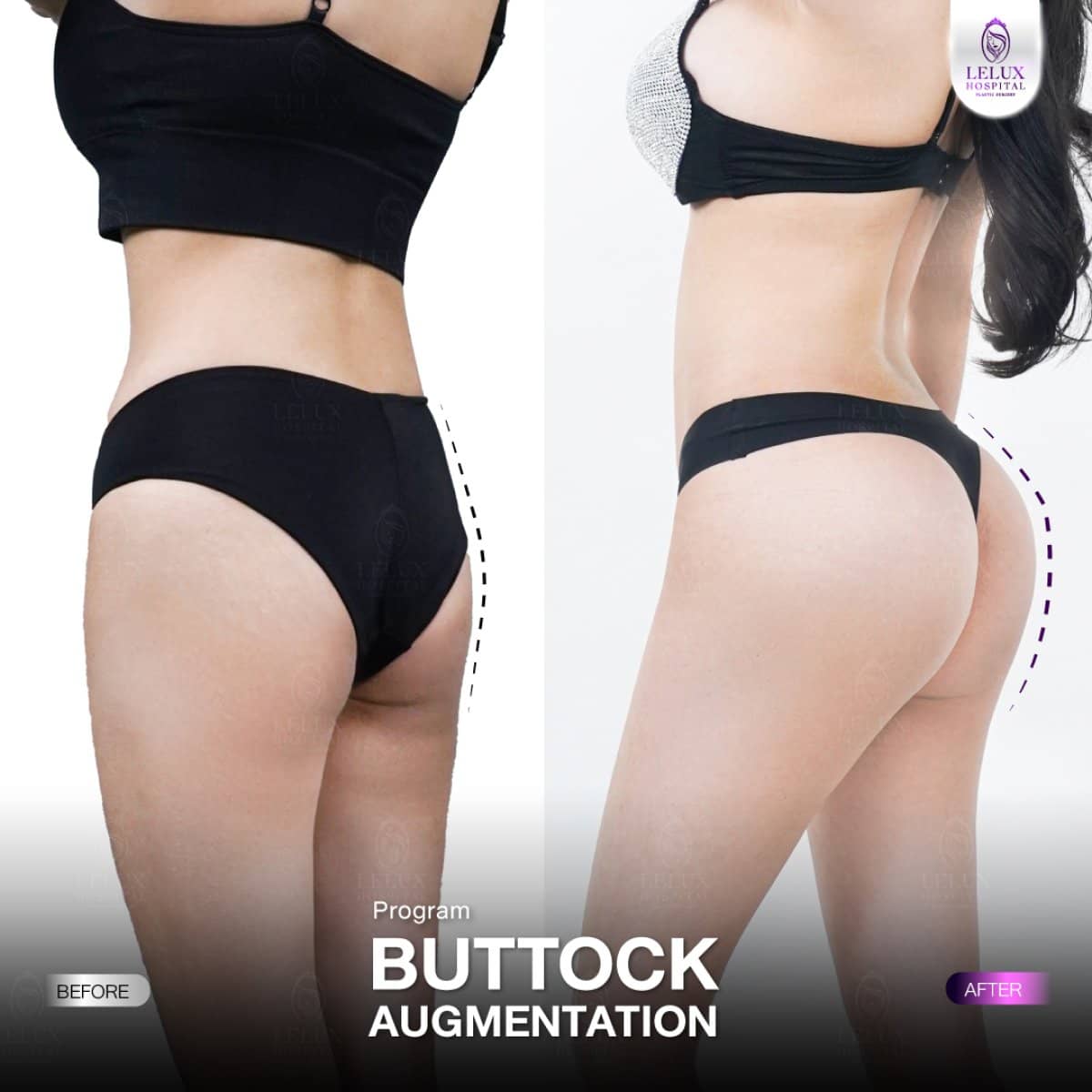 Case 19282 - buttock augmentation