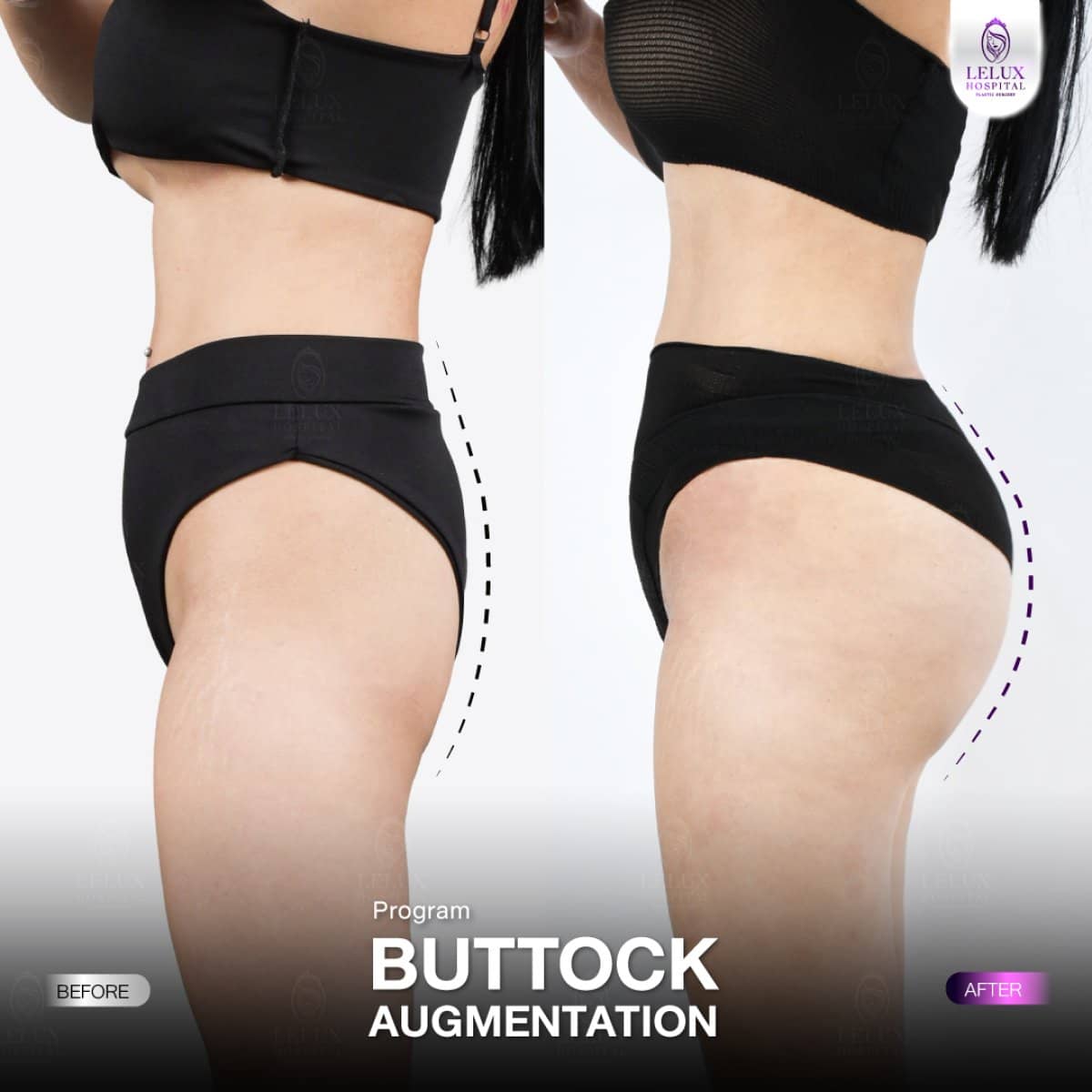 Case 19285 - buttock augmentation