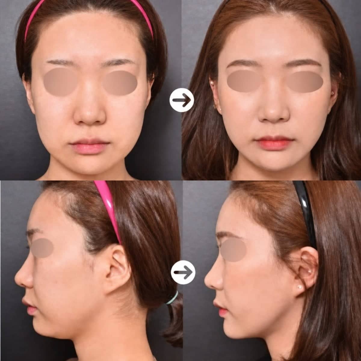 Case 19292 - liposuction