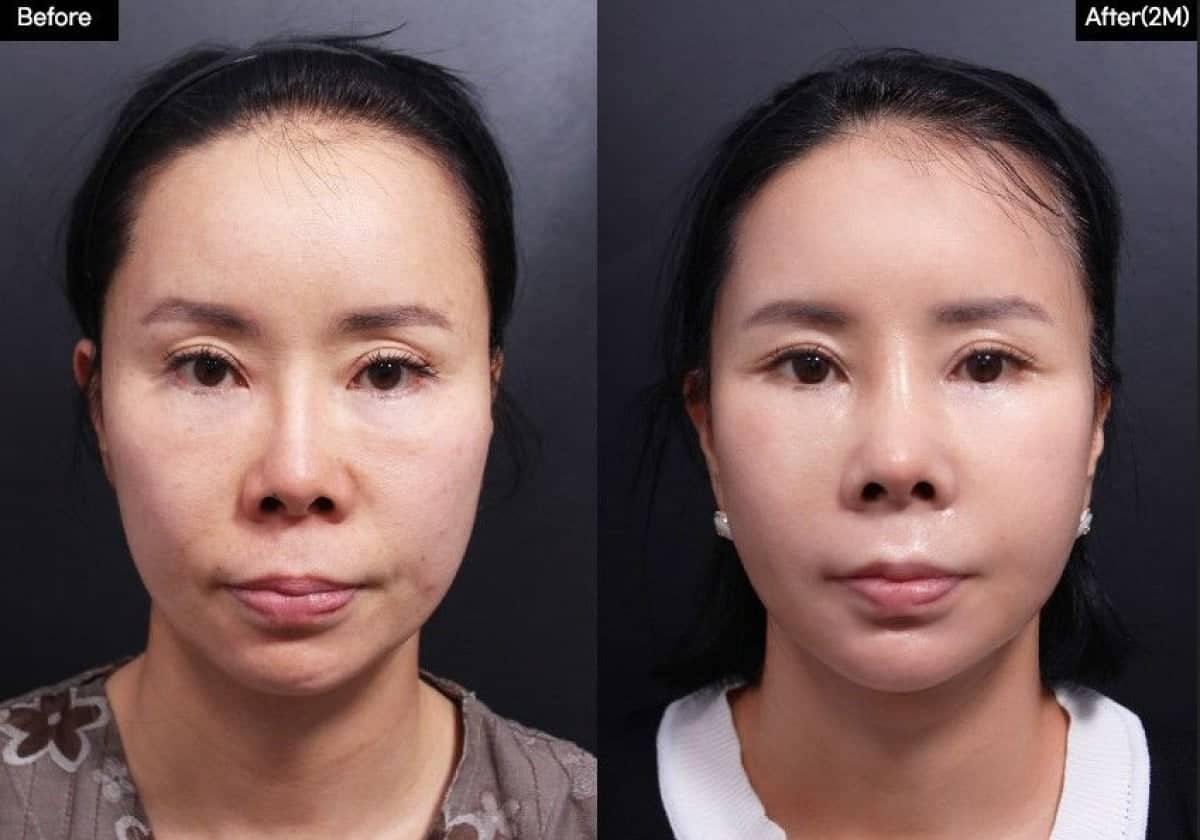 Case 19294 - cheek implants