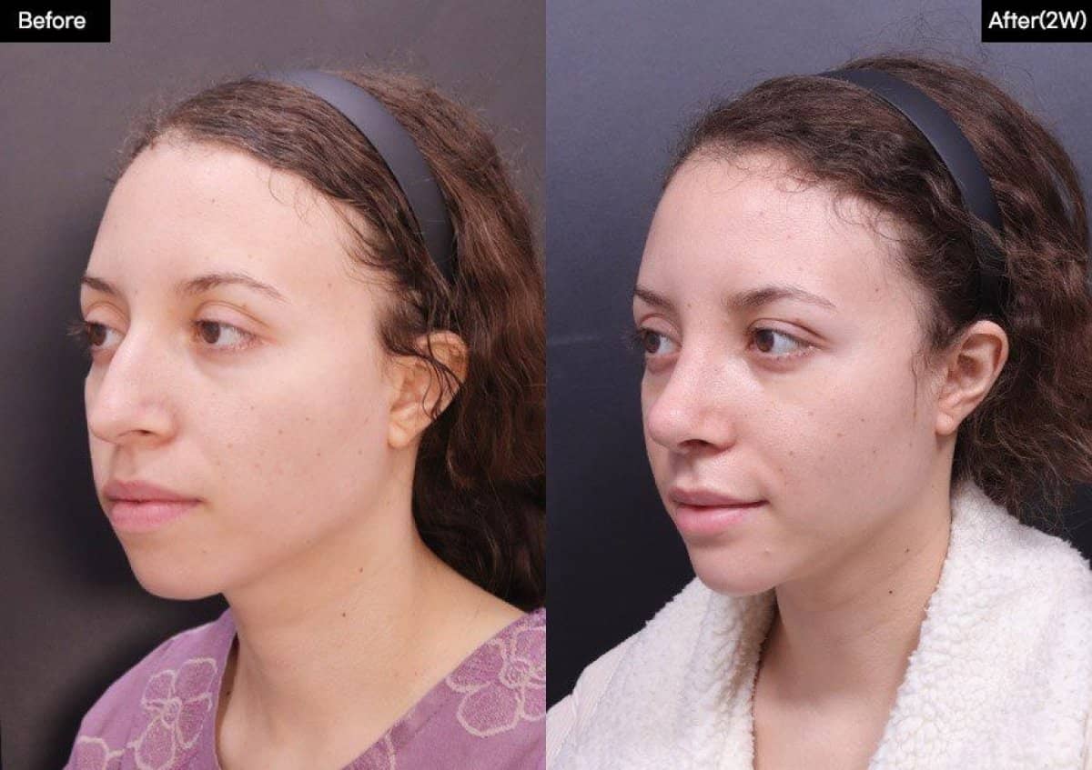 Case 19295 - chin implant
