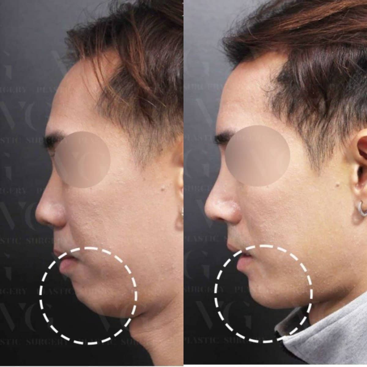 Case 19296 - sliding genioplasty