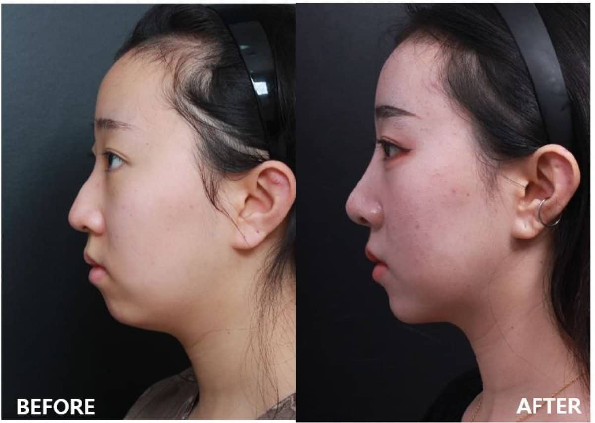 Case 19301 - open rhinoplasty