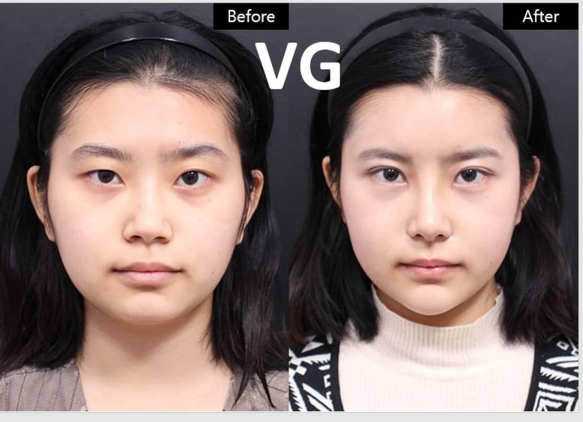 Case 19302 - cheekbone reduction