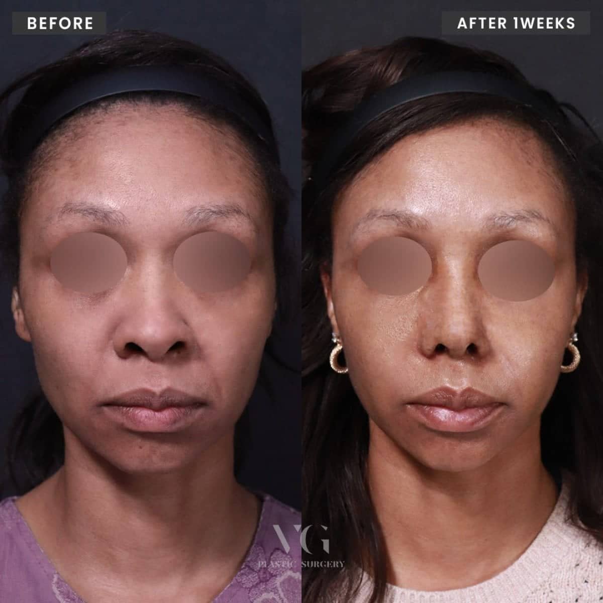 Case 19303 - alarplasty