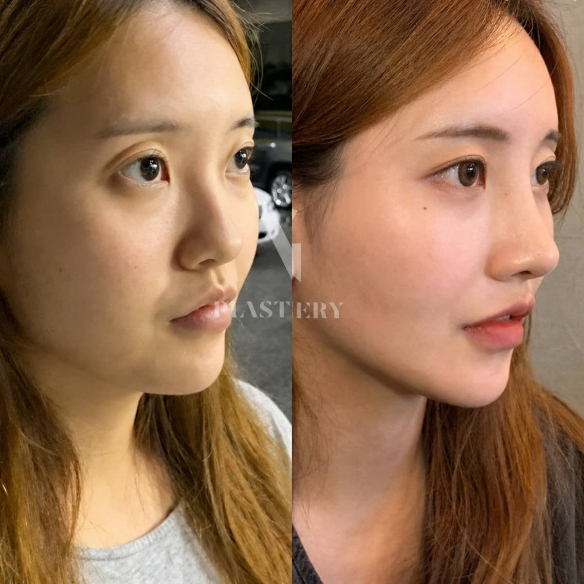 Case 19307 - rhinoplasty
