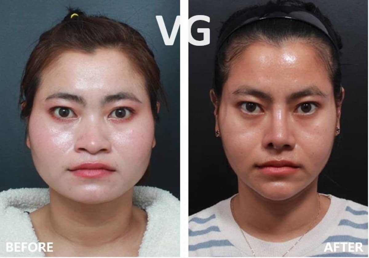 Case 19308 - jawline contouring