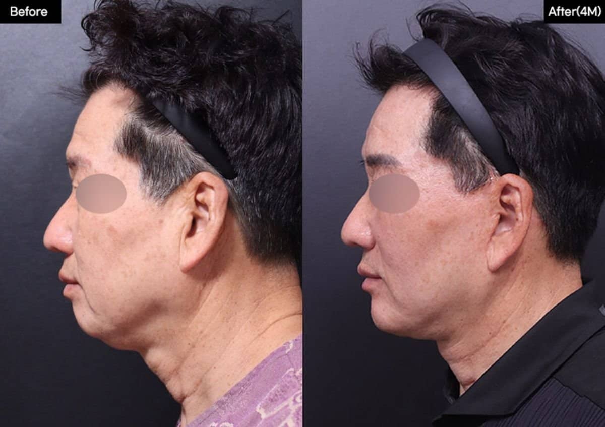 Case 19310 - chin implant