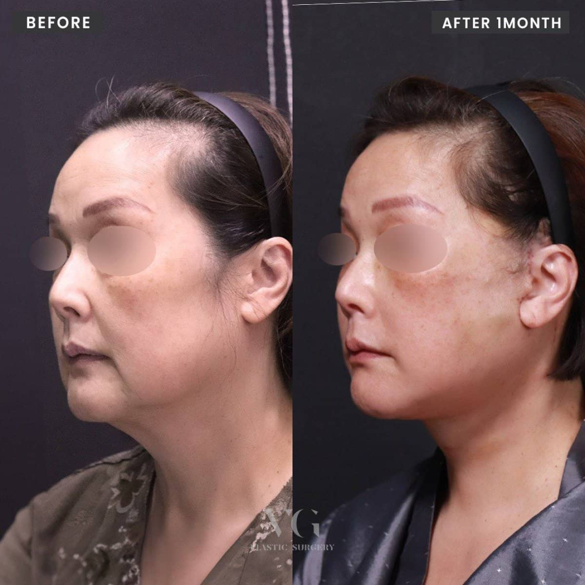 Case 19311 - chin liposuction