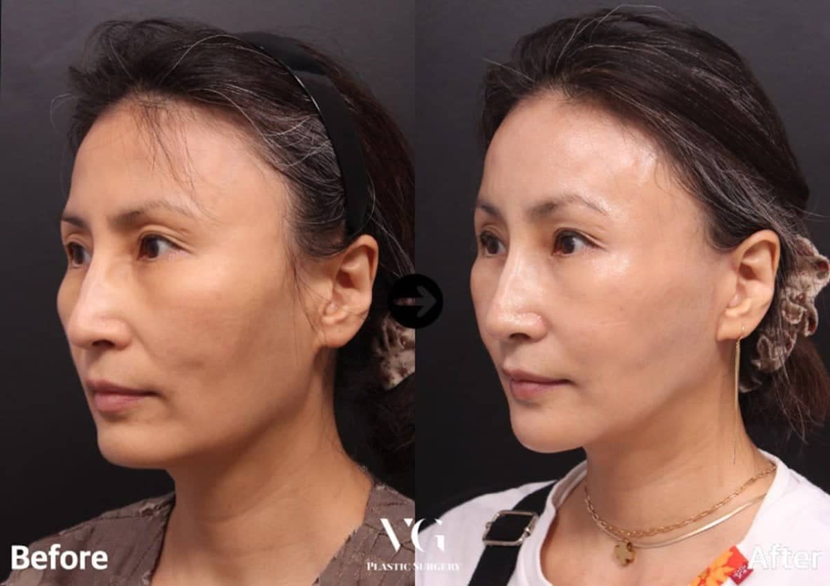 Case 19312 - chin implant