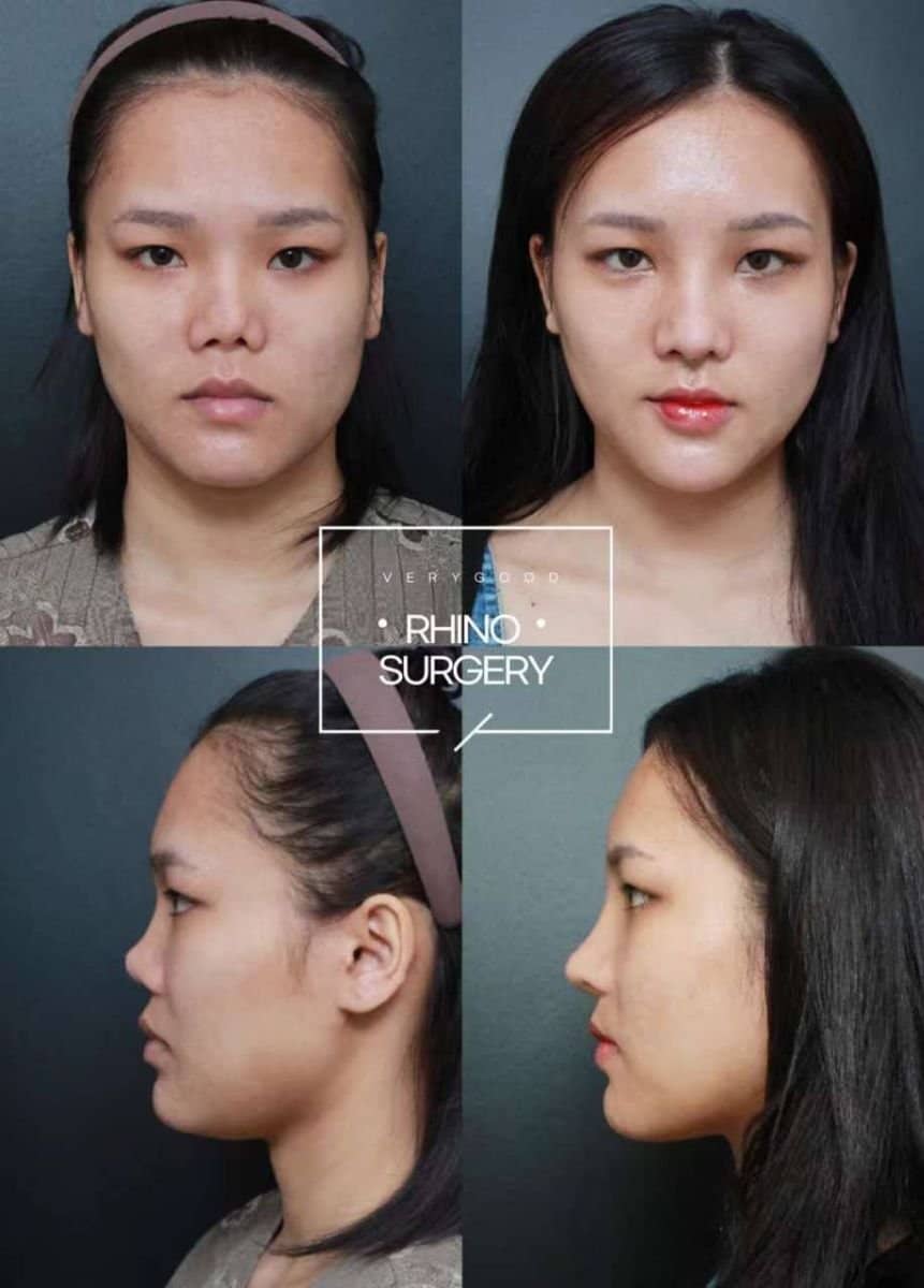 Case 19316 - rhinoplasty