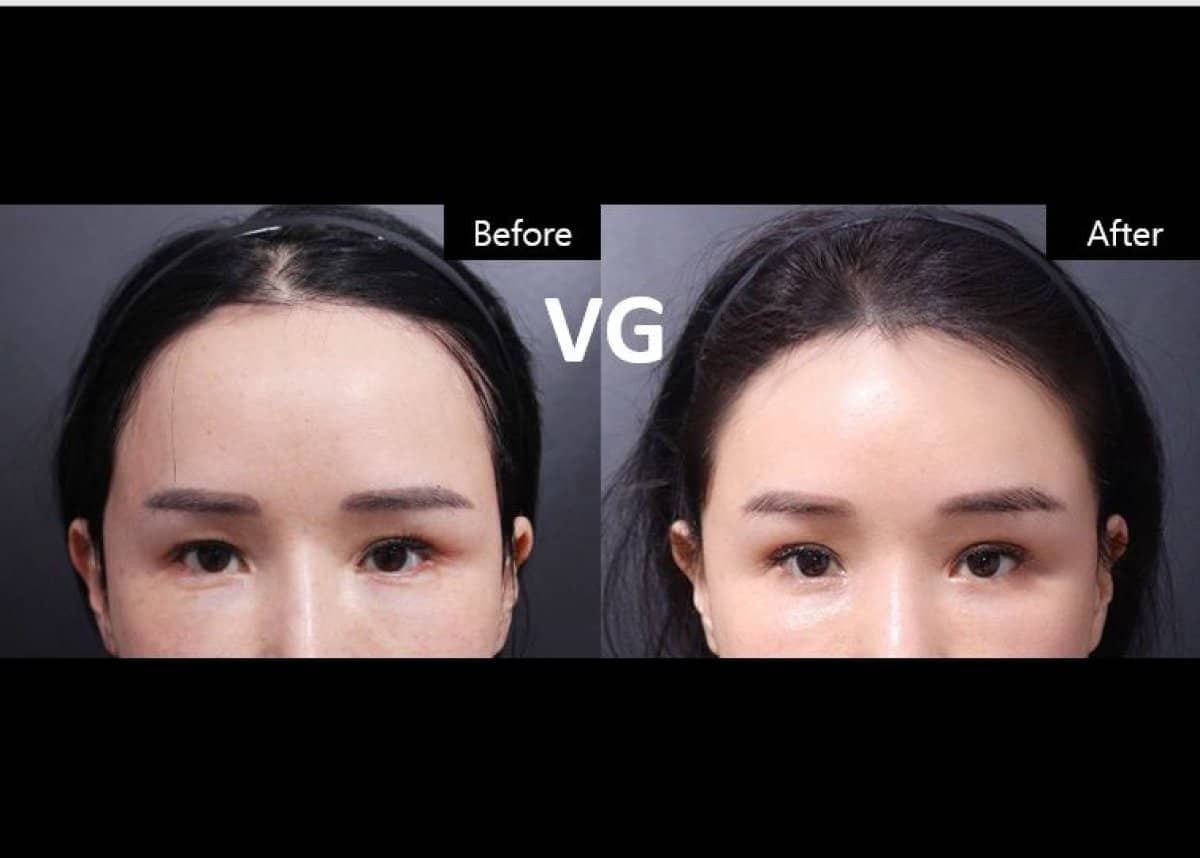 Case 19318 - Botox injections