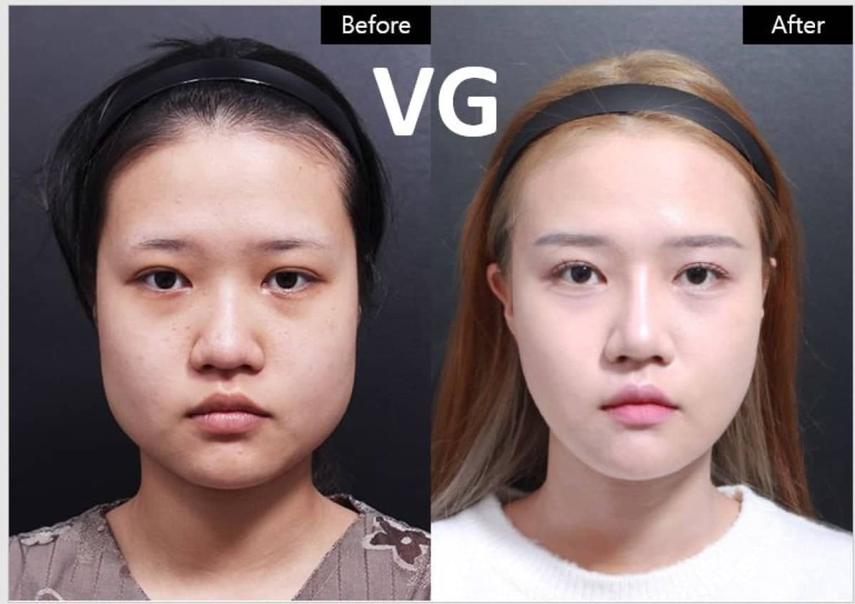 Case 19319 - cheekbone reduction