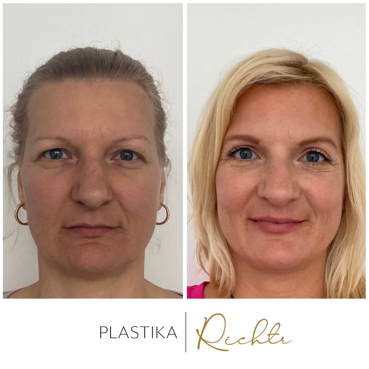Case 19337 - blepharoplasty