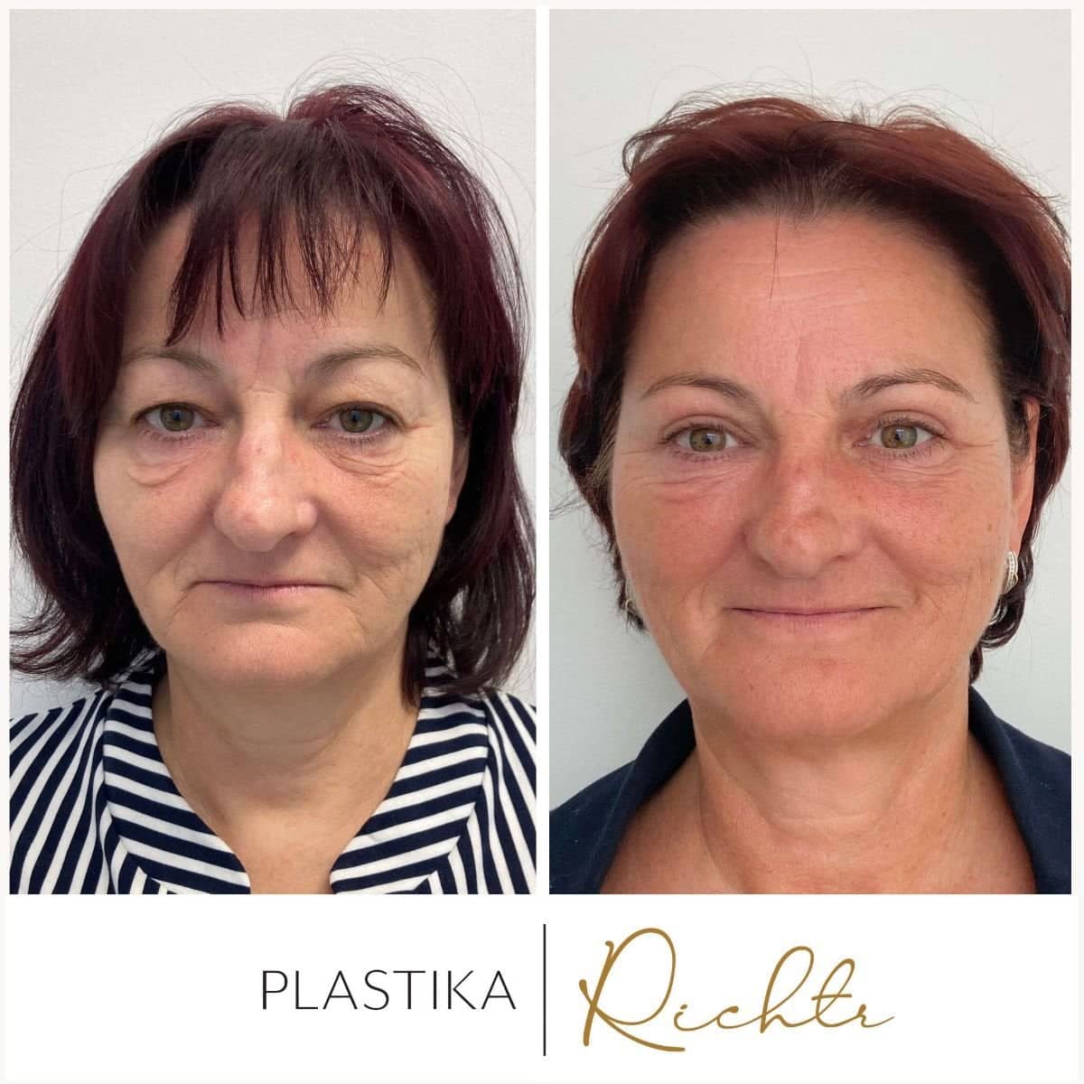 Case 19339 - blepharoplasty