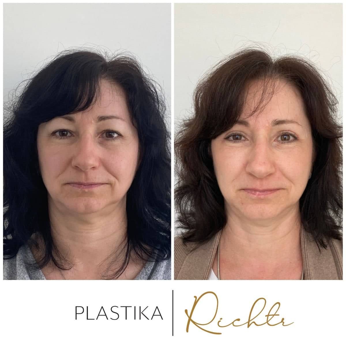 Case 19342 - blepharoplasty