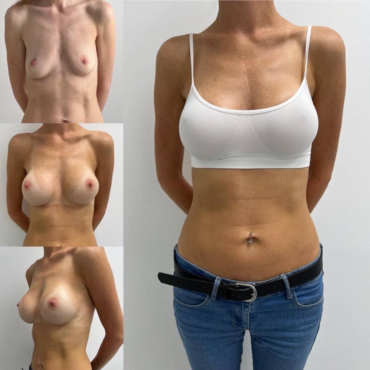 Case 19343 - breast augmentation