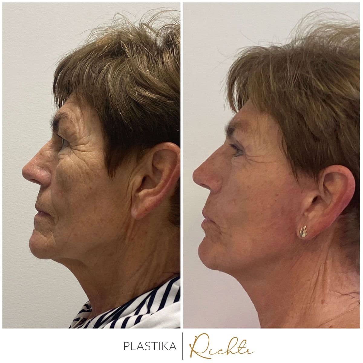 Case 19345 - brow lift