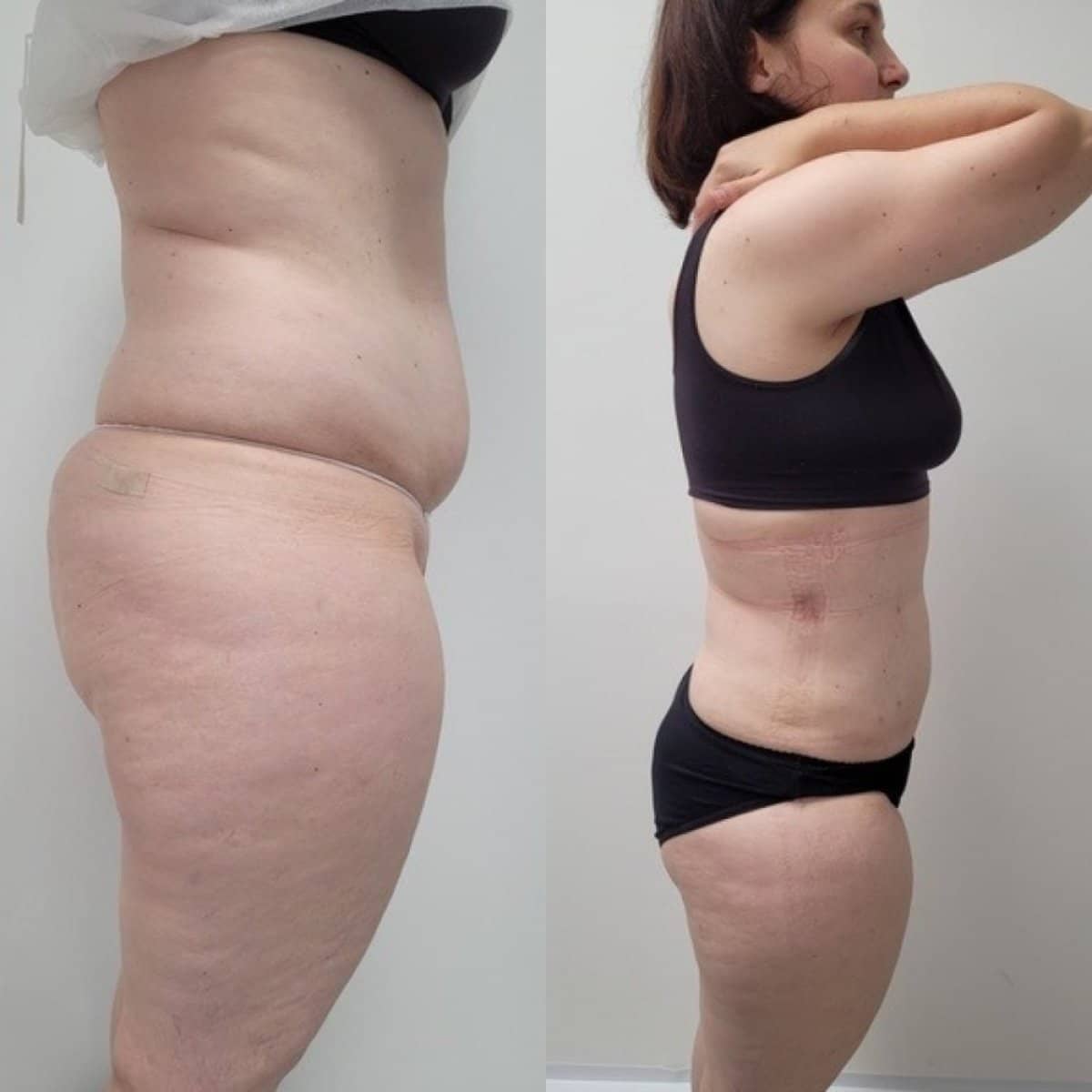 Case 19346 - tummy tuck