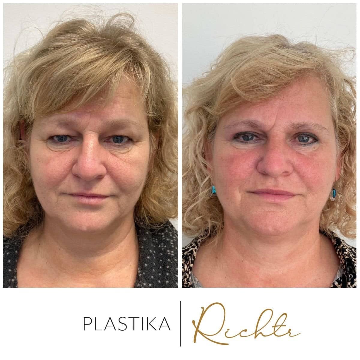 Case 19348 - blepharoplasty
