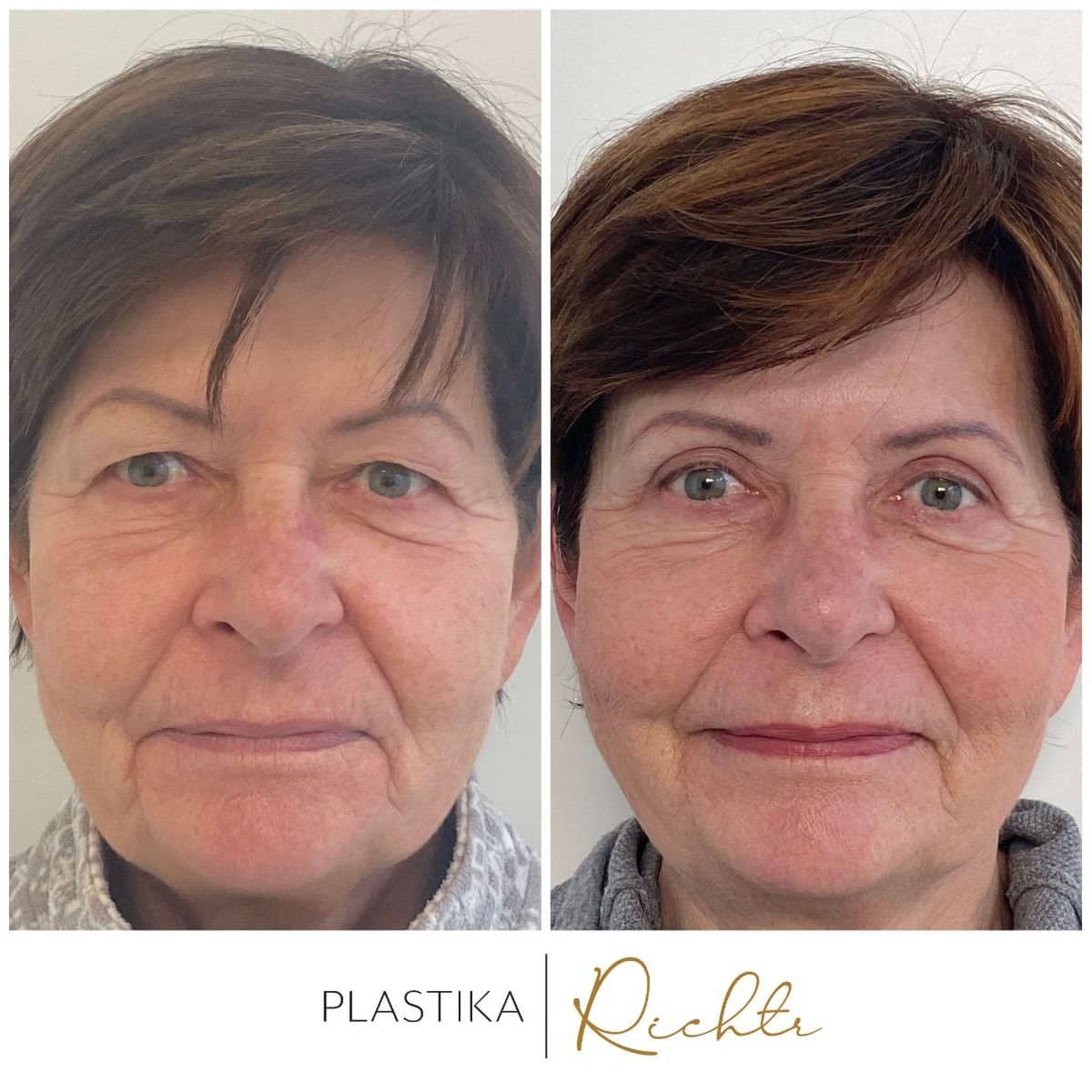 Case 19350 - blepharoplasty