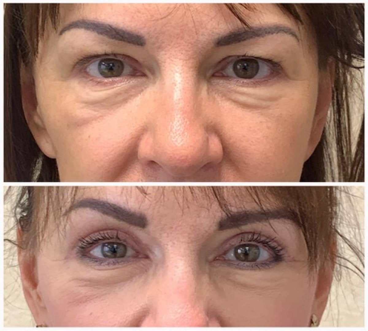 Case 19352 - blepharoplasty