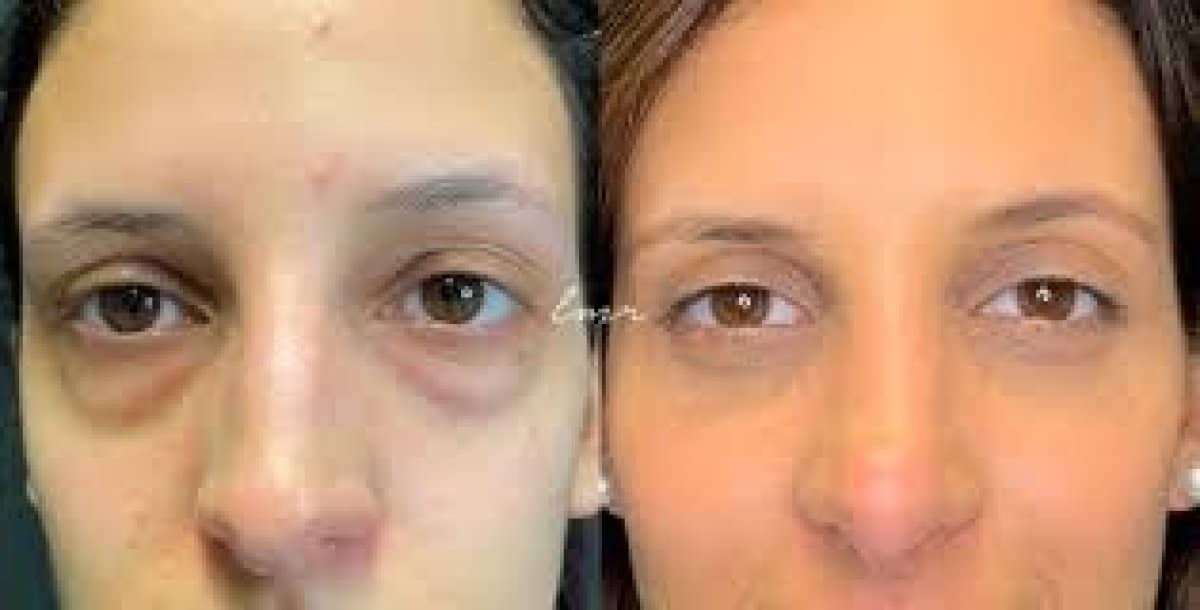 Case 19392 - blepharoplasty