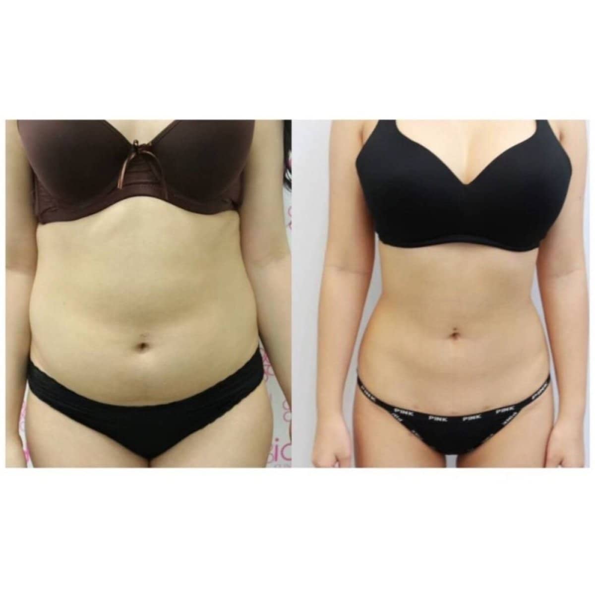 Case 19401 - Vaser liposuction