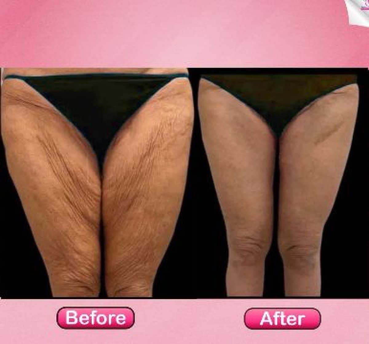 Case 19402 - thigh lift