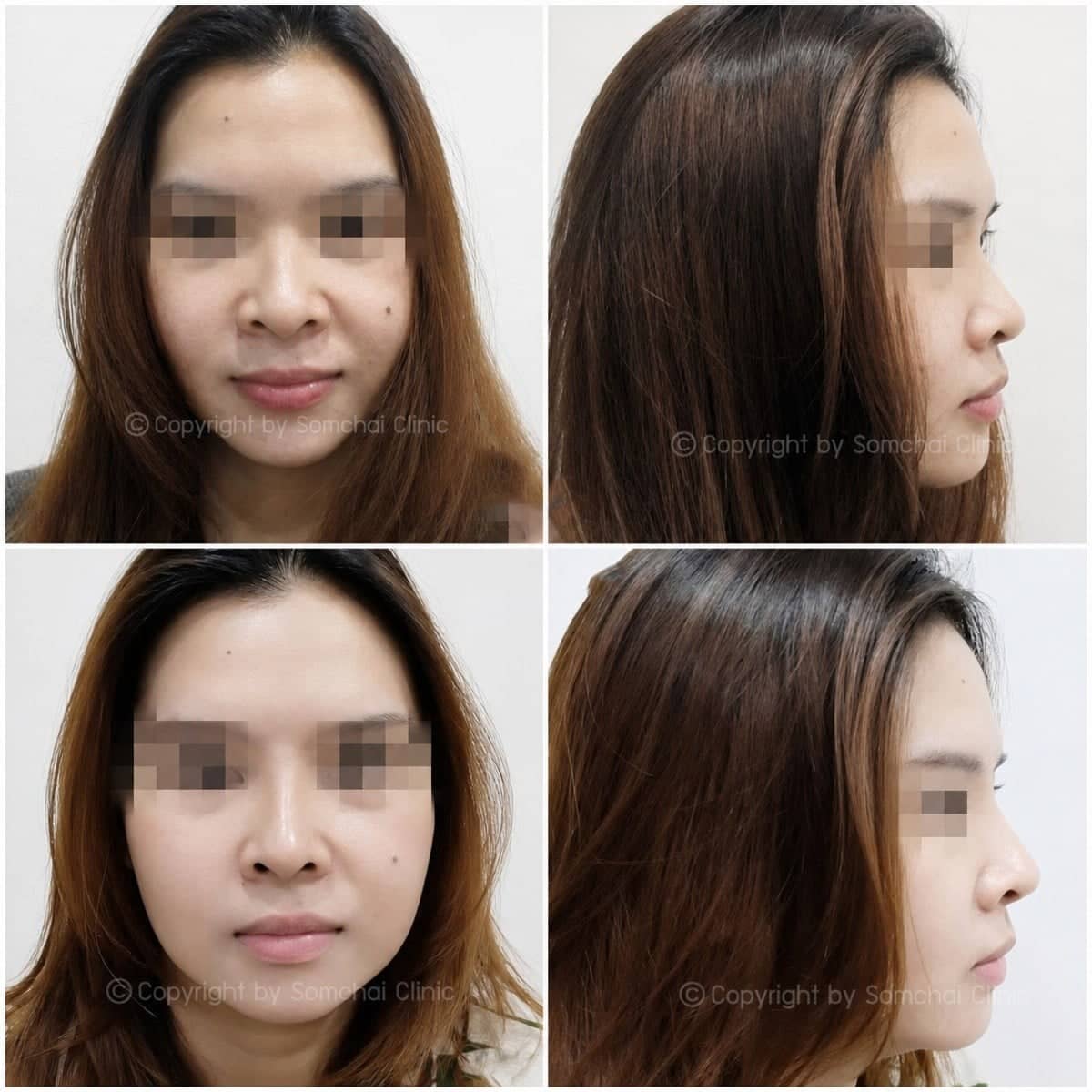 Case 19403 - rhinoplasty