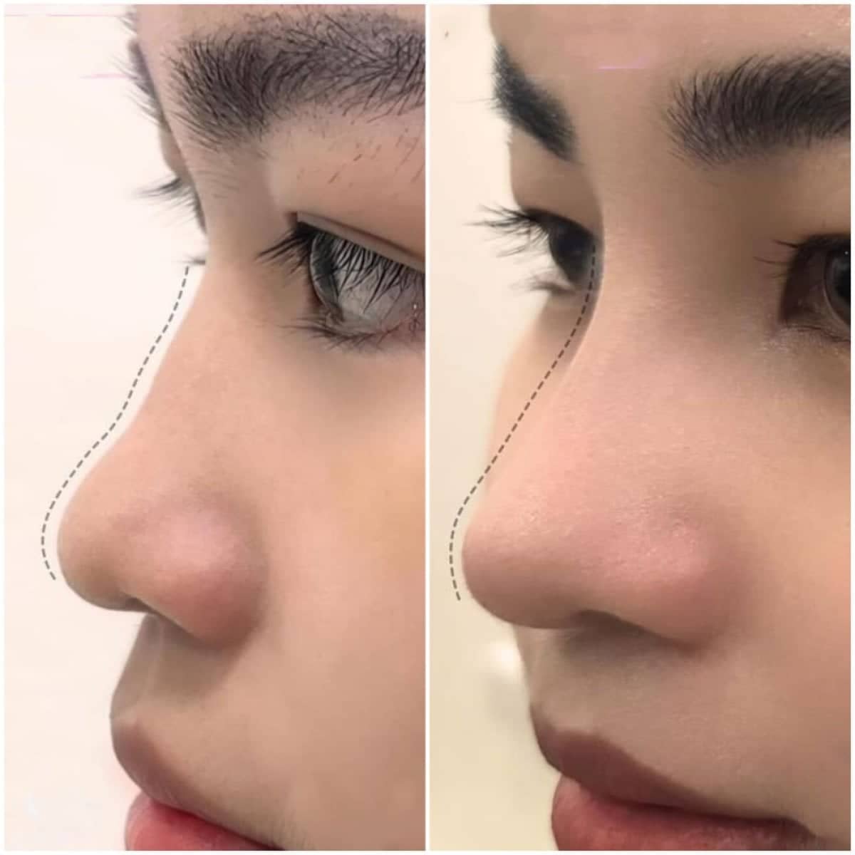 Case 19404 - rhinoplasty