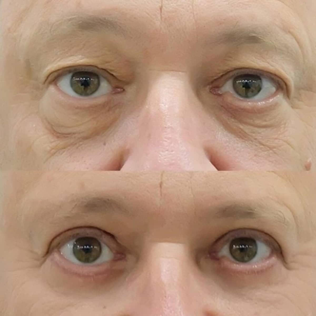 Case 19405 - blepharoplasty