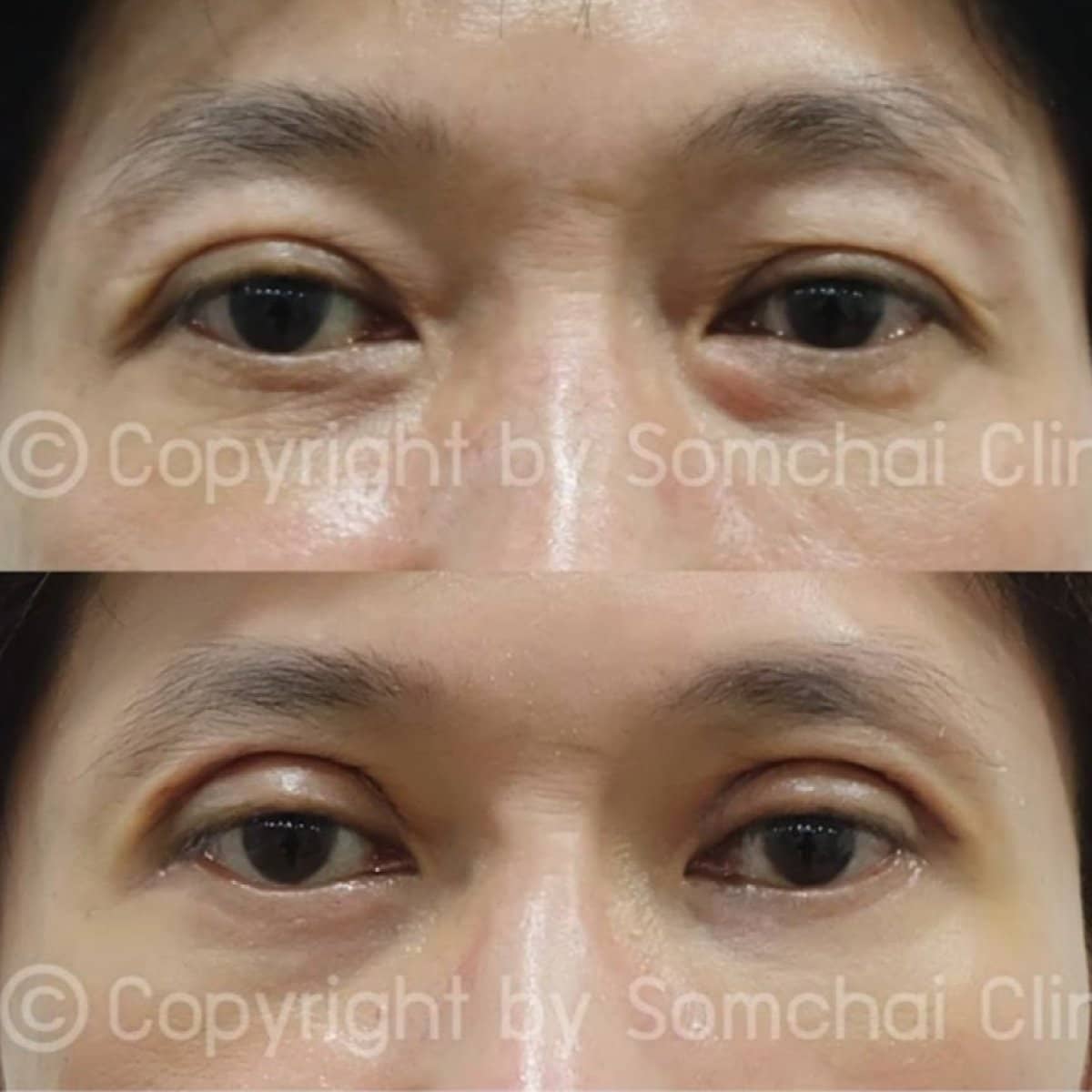 Case 19407 - blepharoplasty