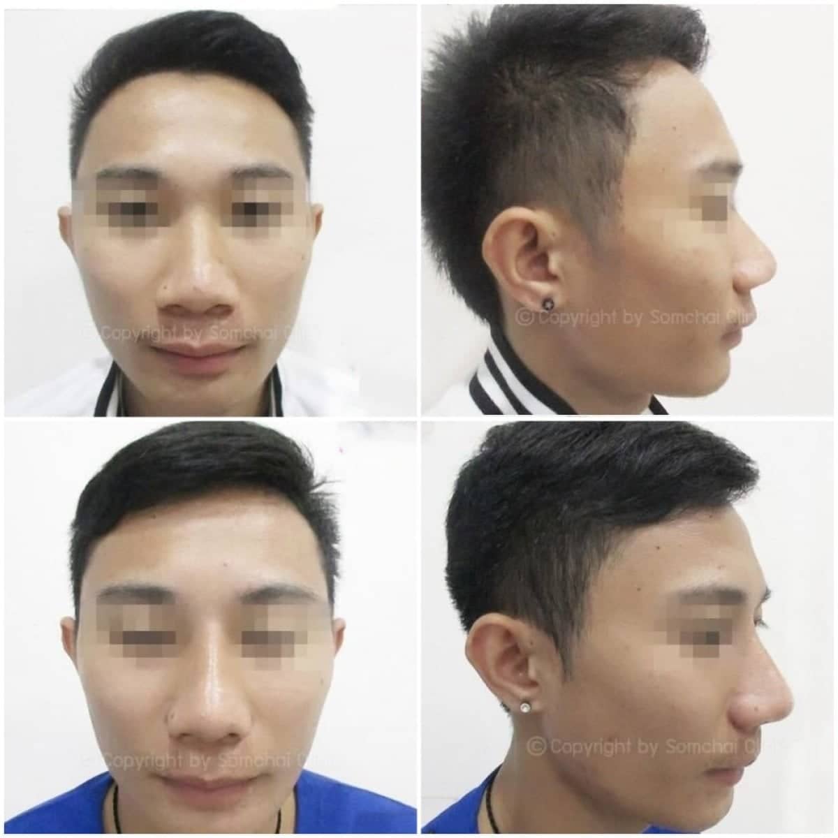 Case 19408 - rhinoplasty