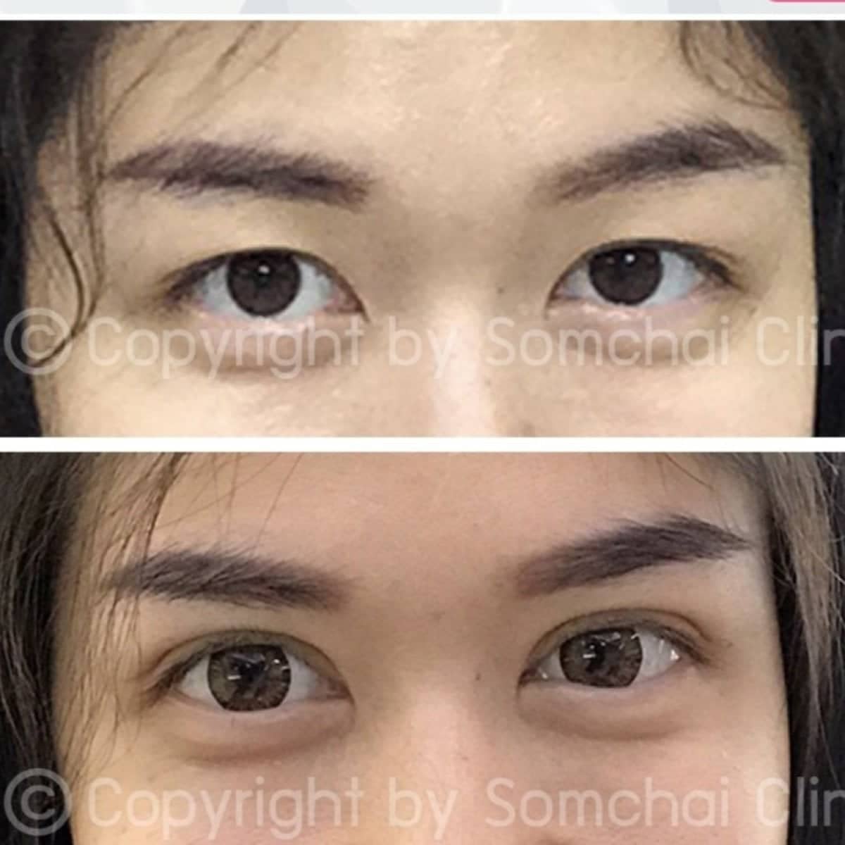 Case 19409 - blepharoplasty