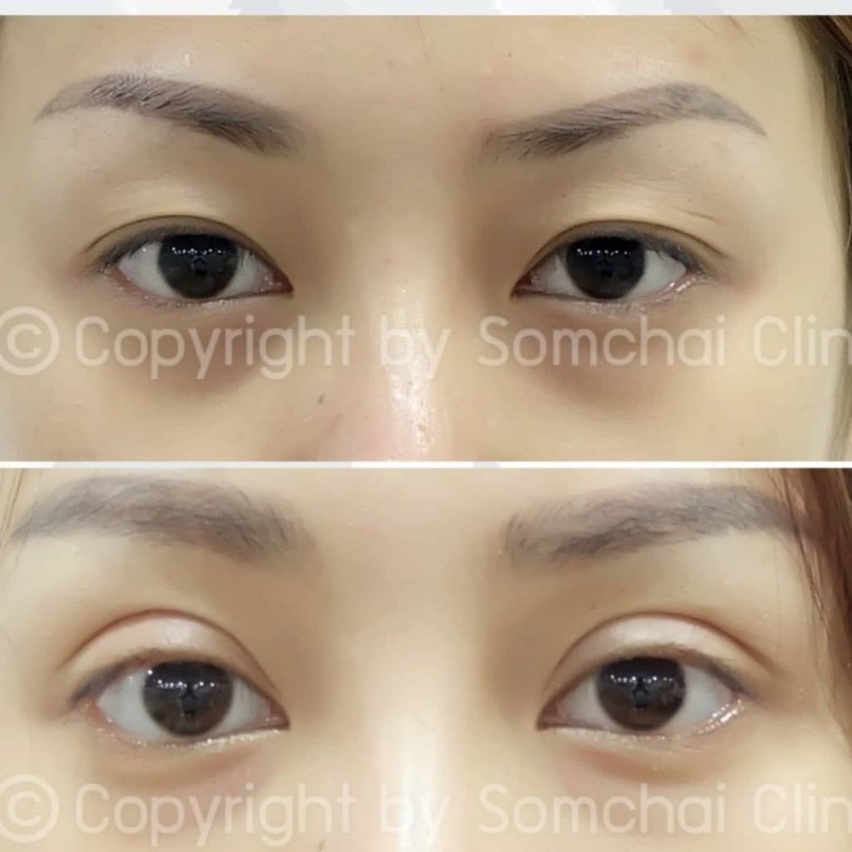 Case 19410 - blepharoplasty