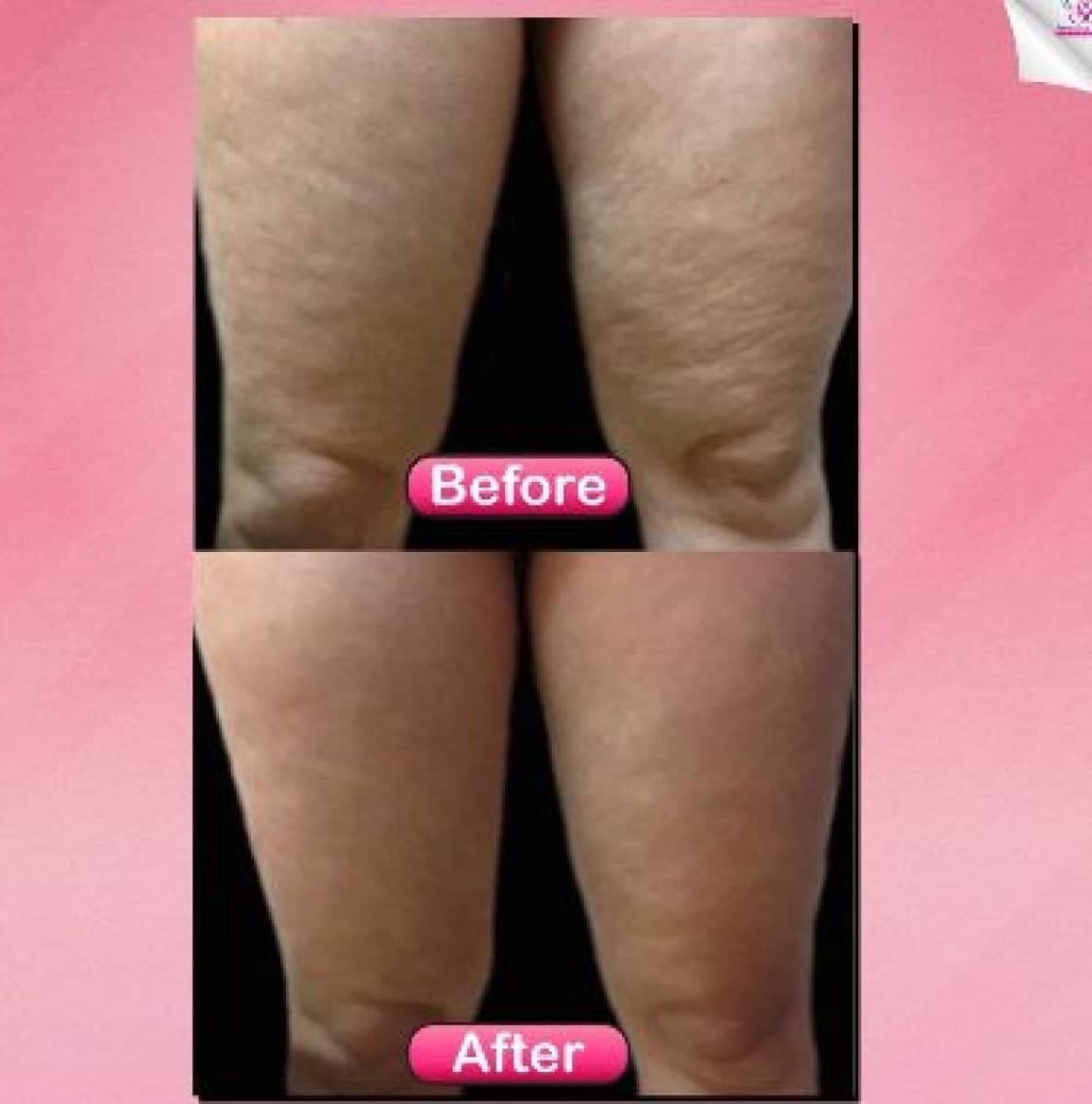 Case 19412 - thigh lift