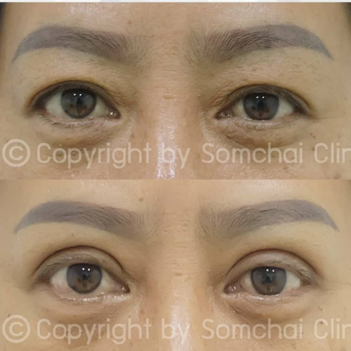Case 19413 - blepharoplasty