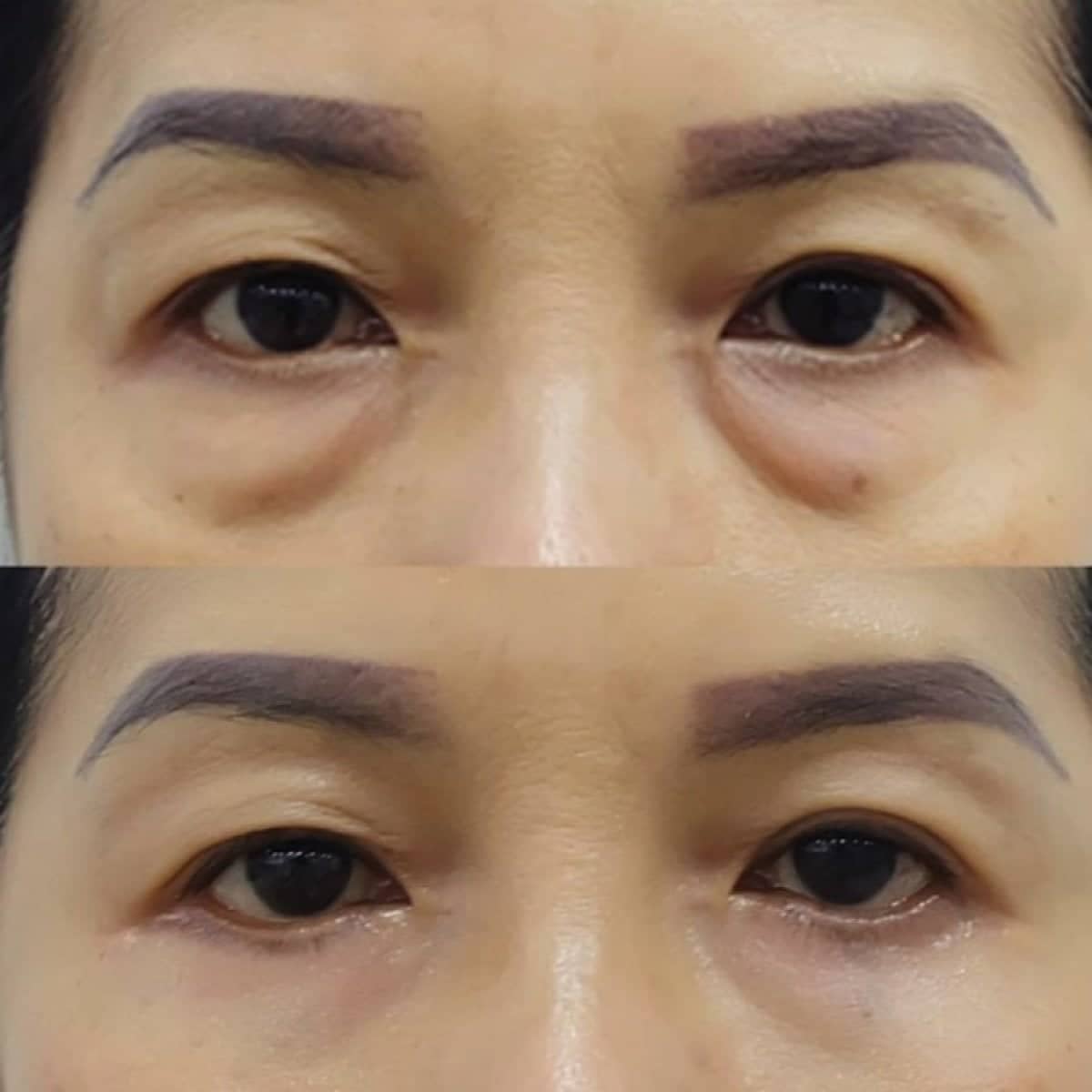 Case 19415 - blepharoplasty