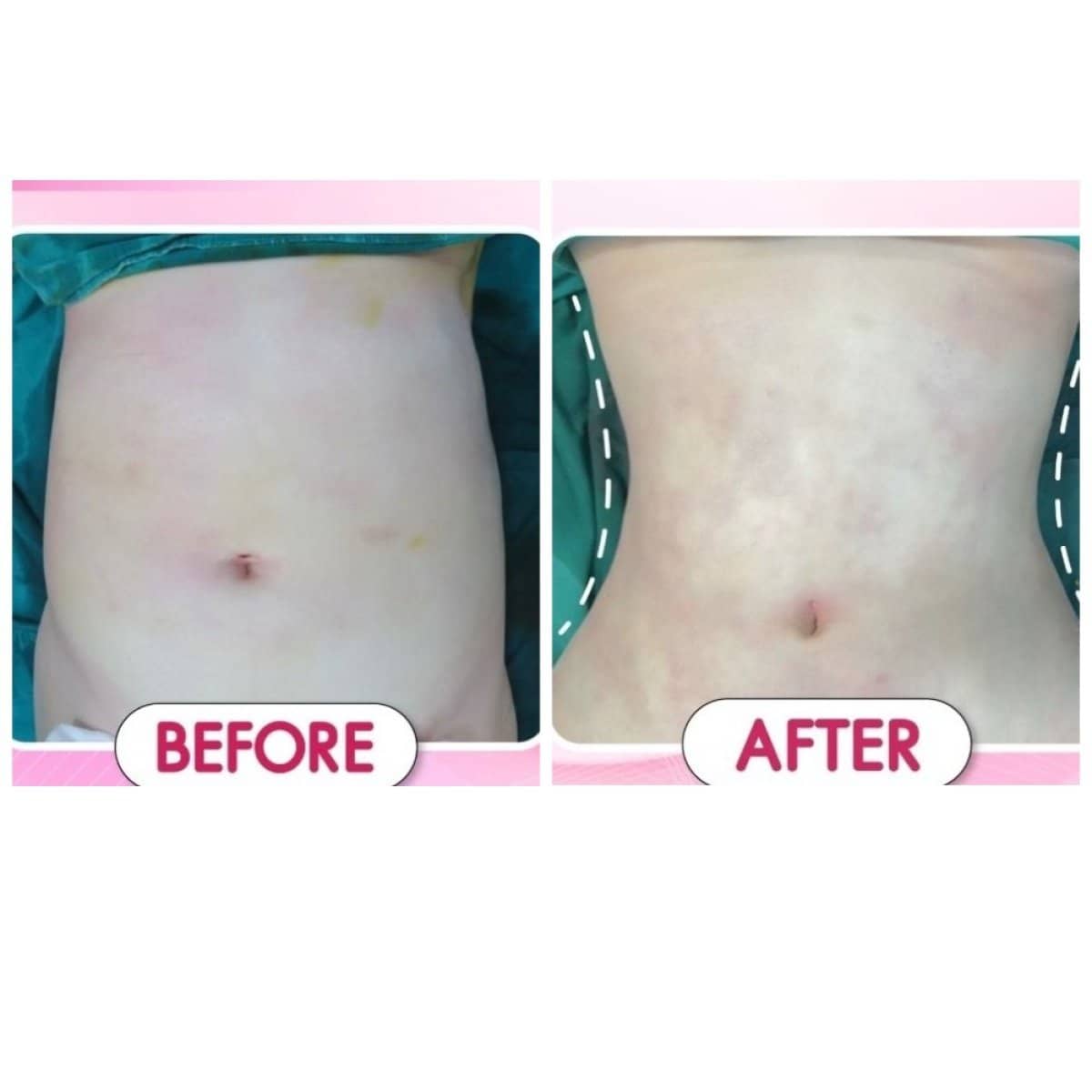 Case 19416 - Vaser liposuction