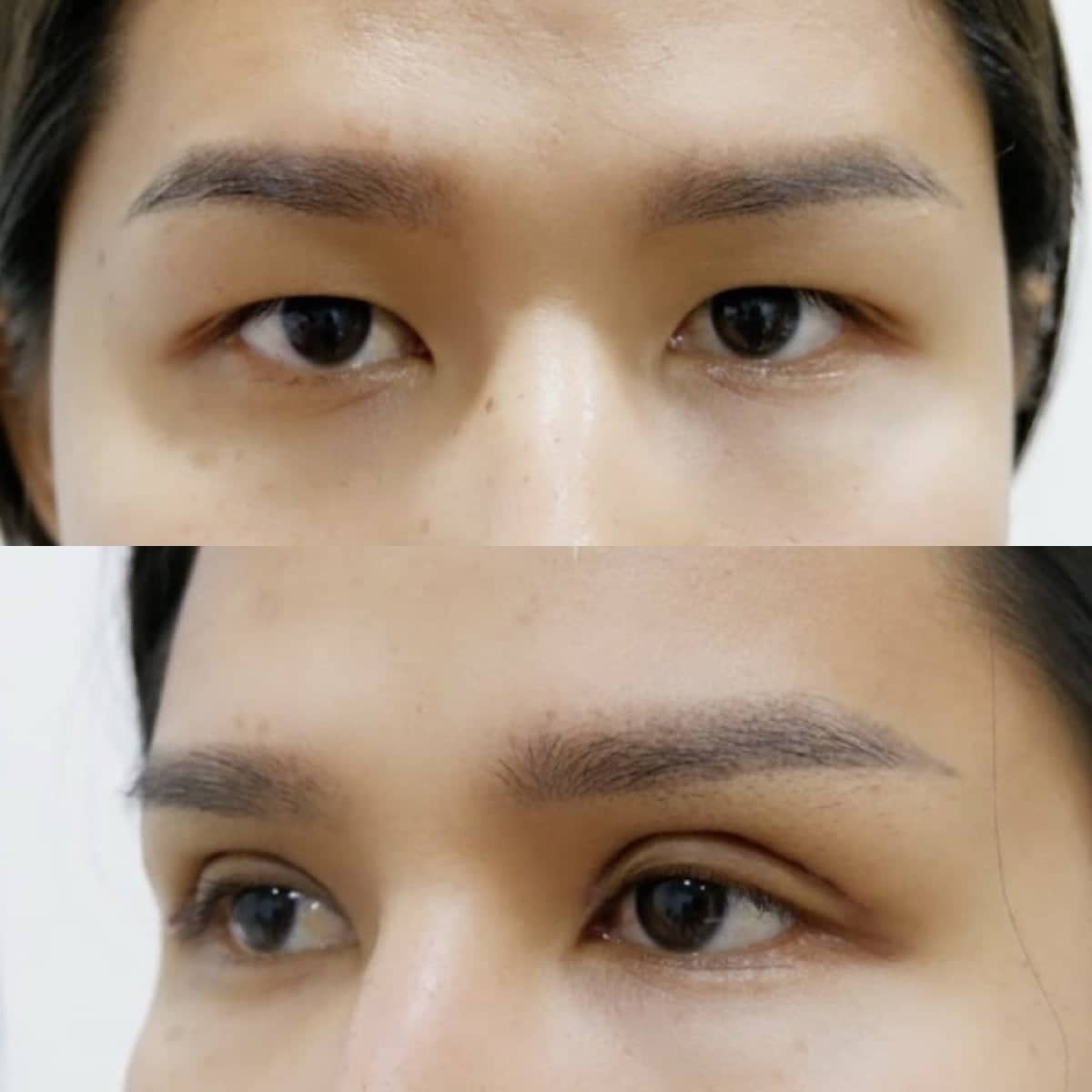 Case 19417 - blepharoplasty