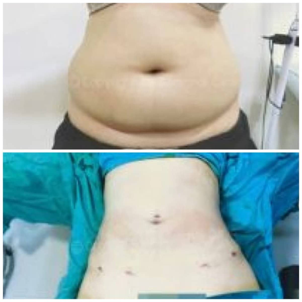 Case 19421 - Vaser liposuction
