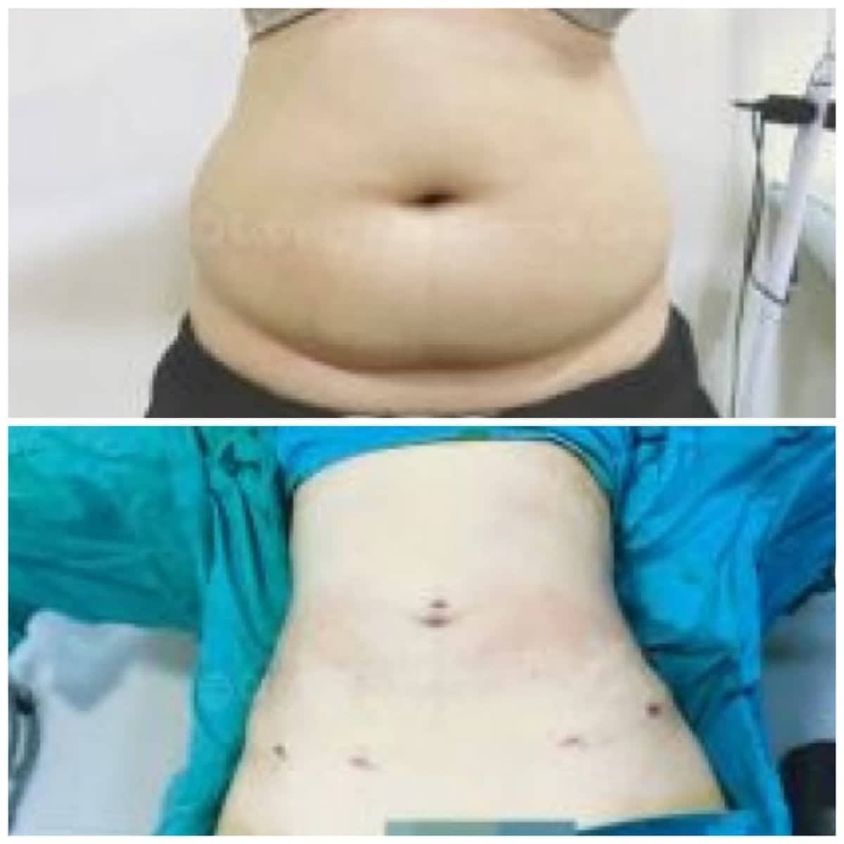 Case 19423 - liposuction